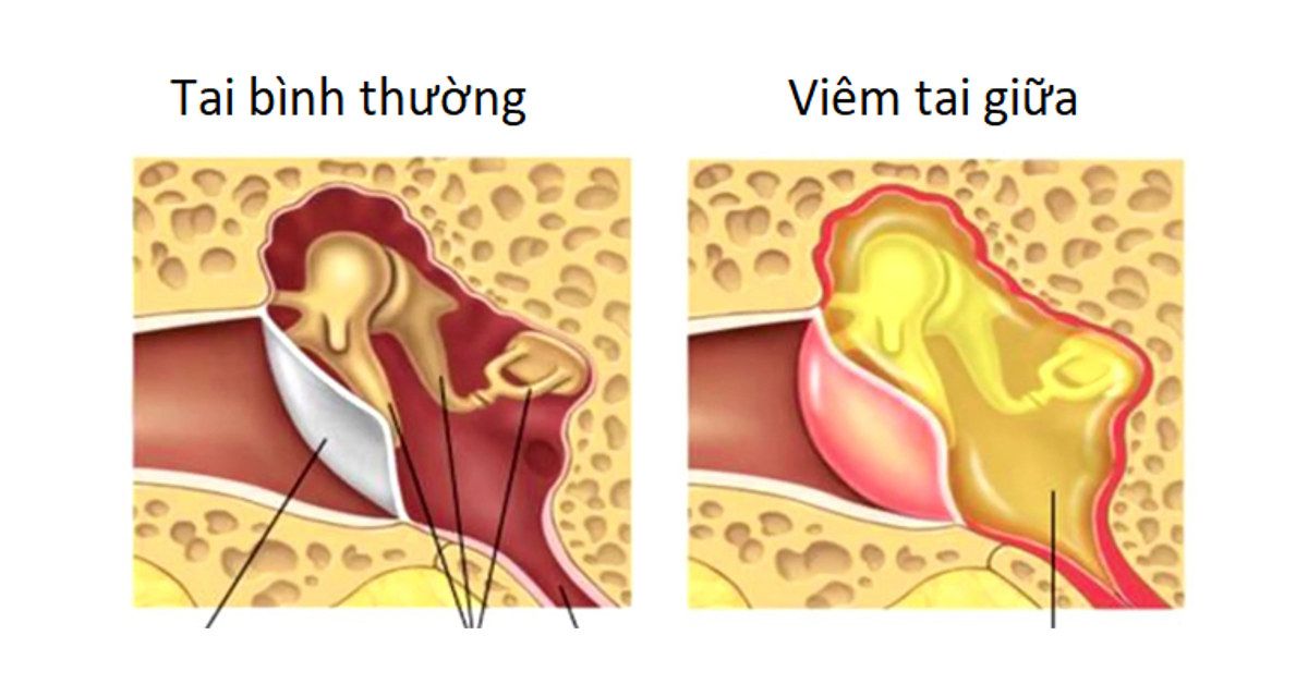 Phòng bệnh viêm tai giữa do phế cầu khuẩn